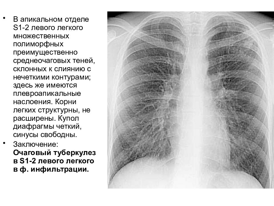 Картина множественных очагов. Апикальные наслоения рентген. Фиброзно очаговый туберкулез рентген. Плевральные наслоения рентген. Туберкулез с1-2 левого легкого рентген.