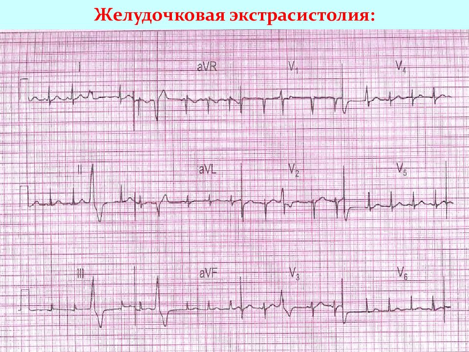 Экг при нарушениях ритма и проводимости презентация