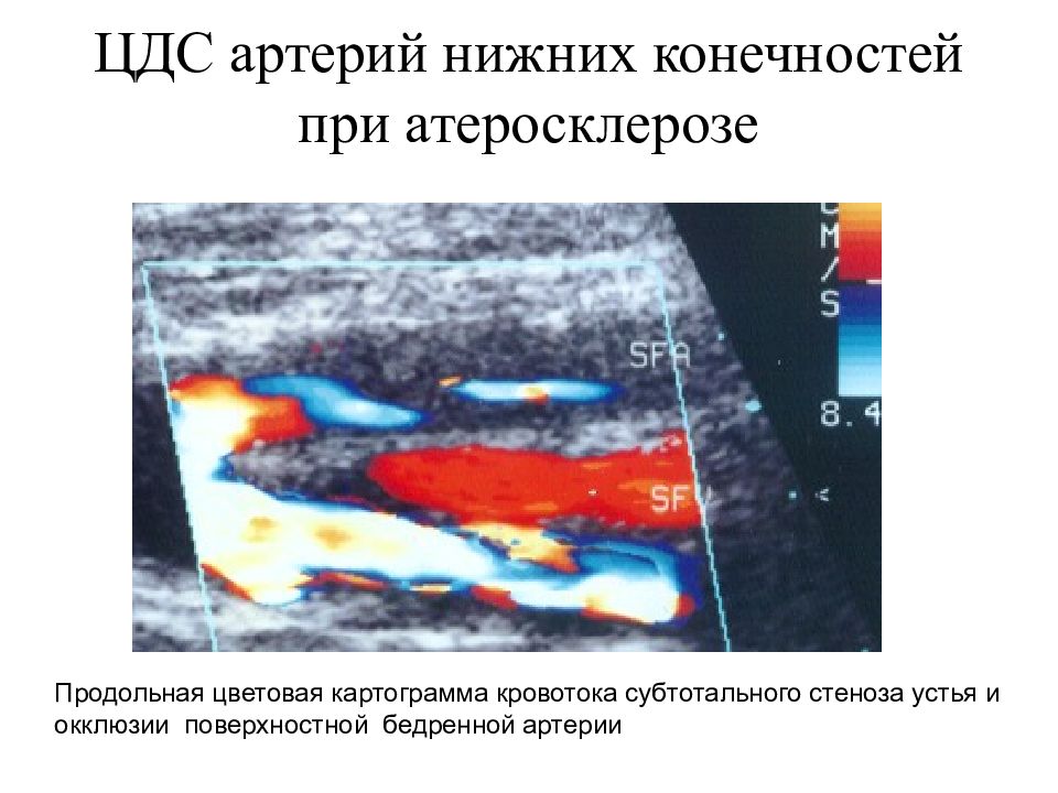 Окклюзия кровотока. УЗДГ артерий нижних конечностей атеросклероз. УЗДГ атеросклероз нижних конечностей. Атеросклероз сосудов нижних конечностей на УЗИ. Облитерирующий атеросклероз сосудов нижних конечностей УЗДГ.