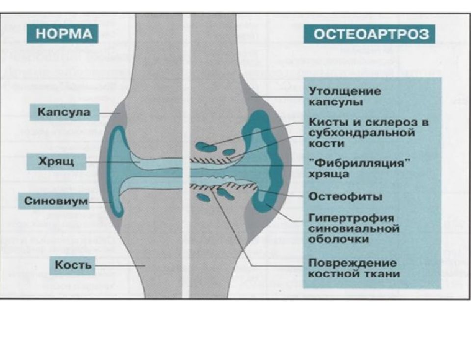 Склероз суставных поверхностей. Субхондральные пластинки коленного сустава. Субхондральный остеоартроз. Субхондральная пластинка бедренной кости. Субхондральная кость тазобедренного сустава.