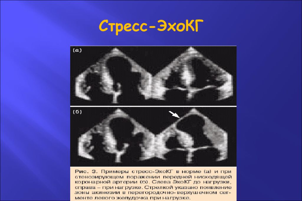 Сердце стресс эхо. Стресс ЭХОКГ. Стресс ЭХОКГ С физической. Стресс ЭХОКГ С физической нагрузкой. Что такой стресс эхокардиоскопия.