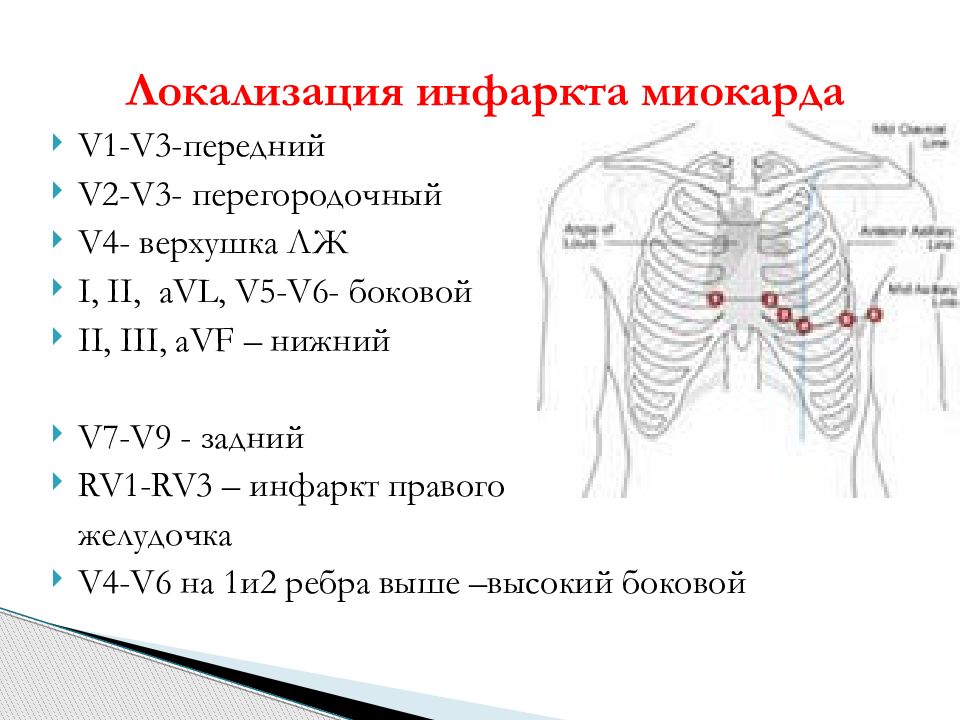 Экг на правую. Инфаркт в отведениях v1-v2. ЭКГ v1 v2 v3 v4. Инфаркт миокарда правого желудочка на ЭКГ дополнительные отведения. Дополнительные отведения при инфаркте правого желудочка.