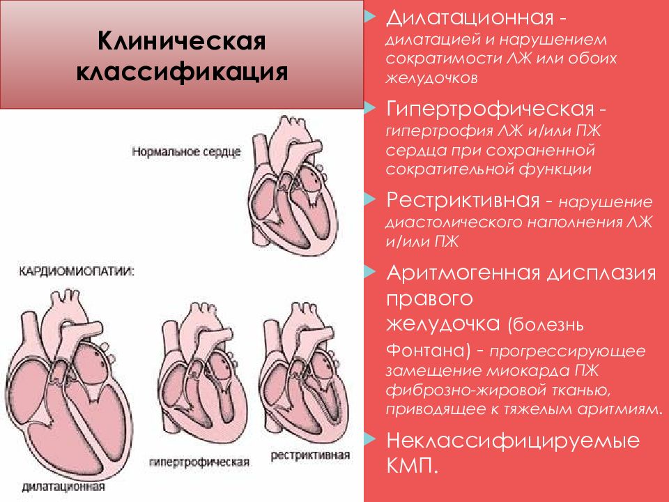 Кардиомиопатии у детей презентация