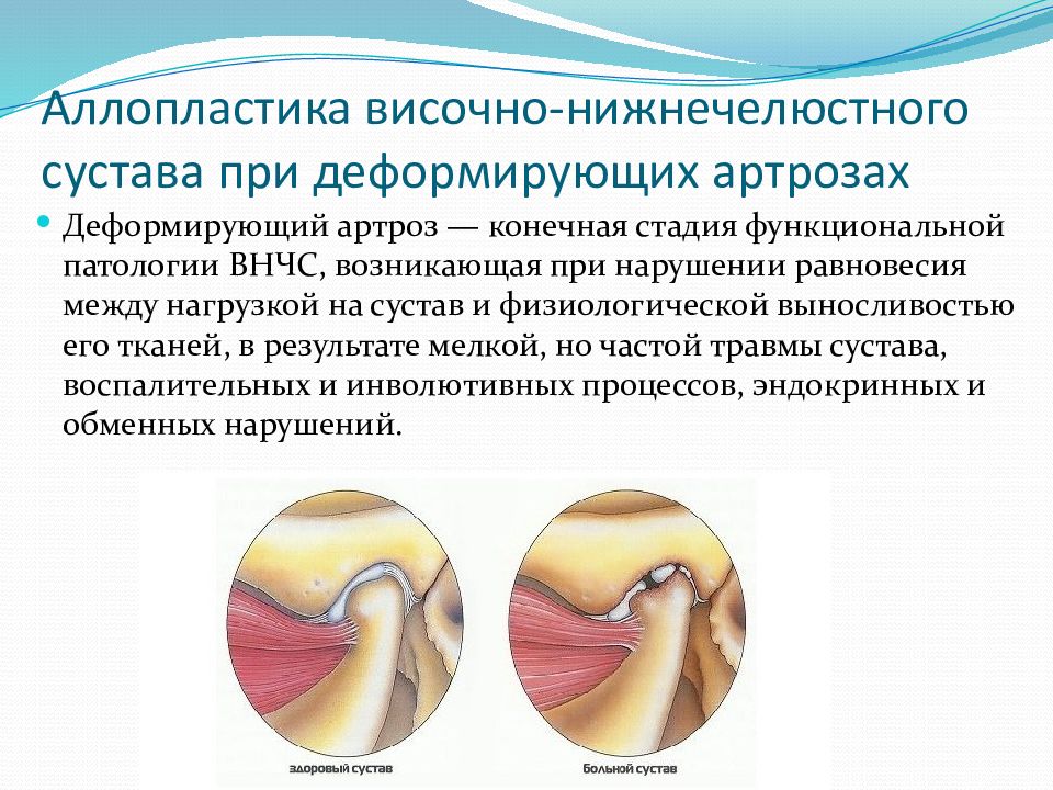 Дисфункция внчс. Эндопротез височно-нижнечелюстного сустава. Аллотрансплантат ВНЧС. ВНЧС классификация сустава. Артроз височной височно-нижнечелюстного сустава.