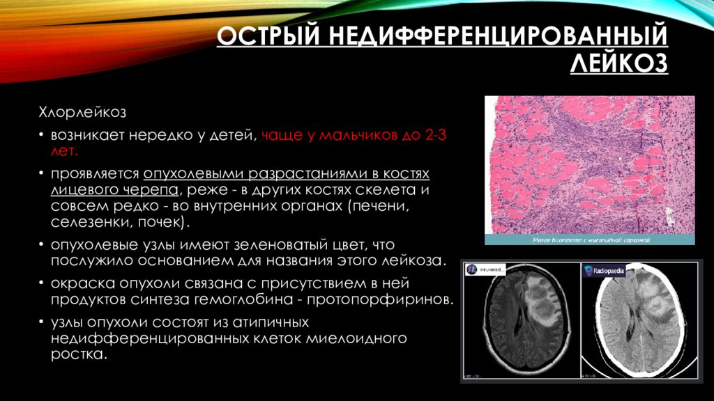 Лейкозы картинки для презентации