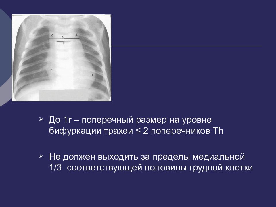 На каком уровне бифуркация трахеи