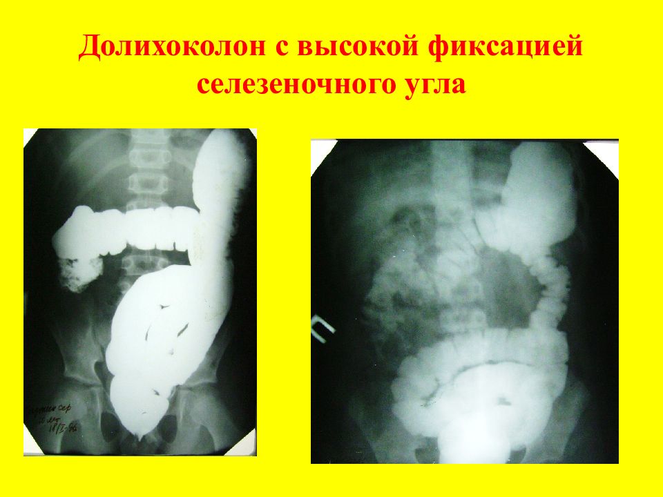 Кт картина долихосигмы это