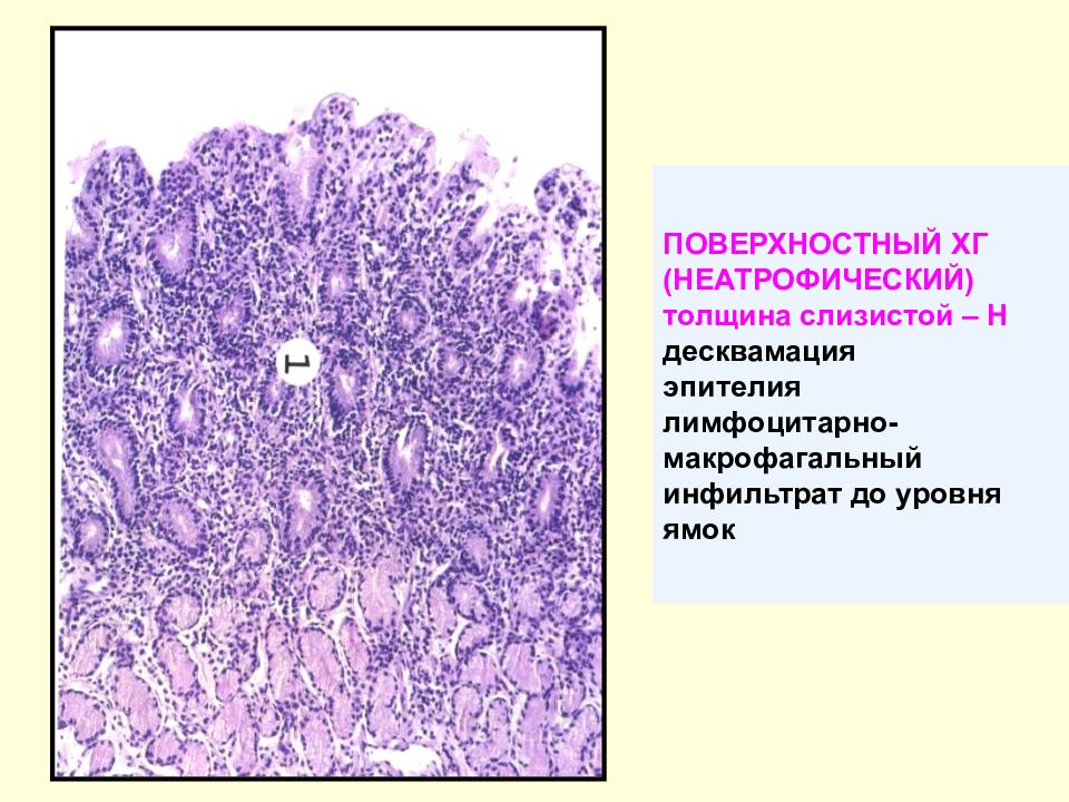 Десквамация. Десквамация кишечного эпителия. Десквамация эпителиальных клеток.