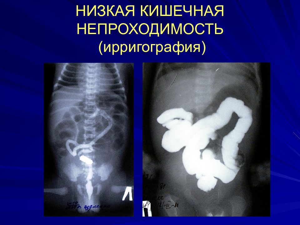 Врожденная кишечная непроходимость презентация