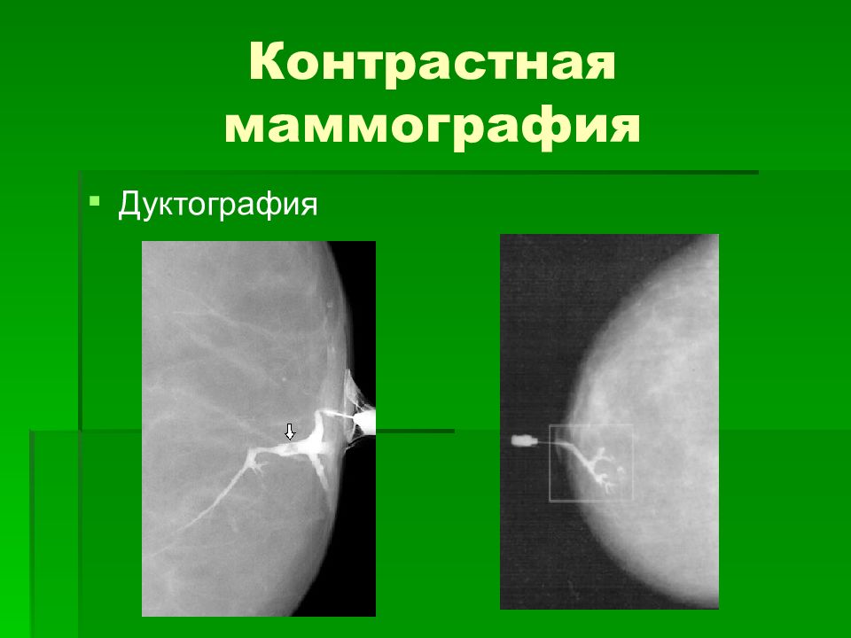 Маммография дуктография. Дуктография (галактография). Дуктография молочной железы. Дуктография мастопатия.