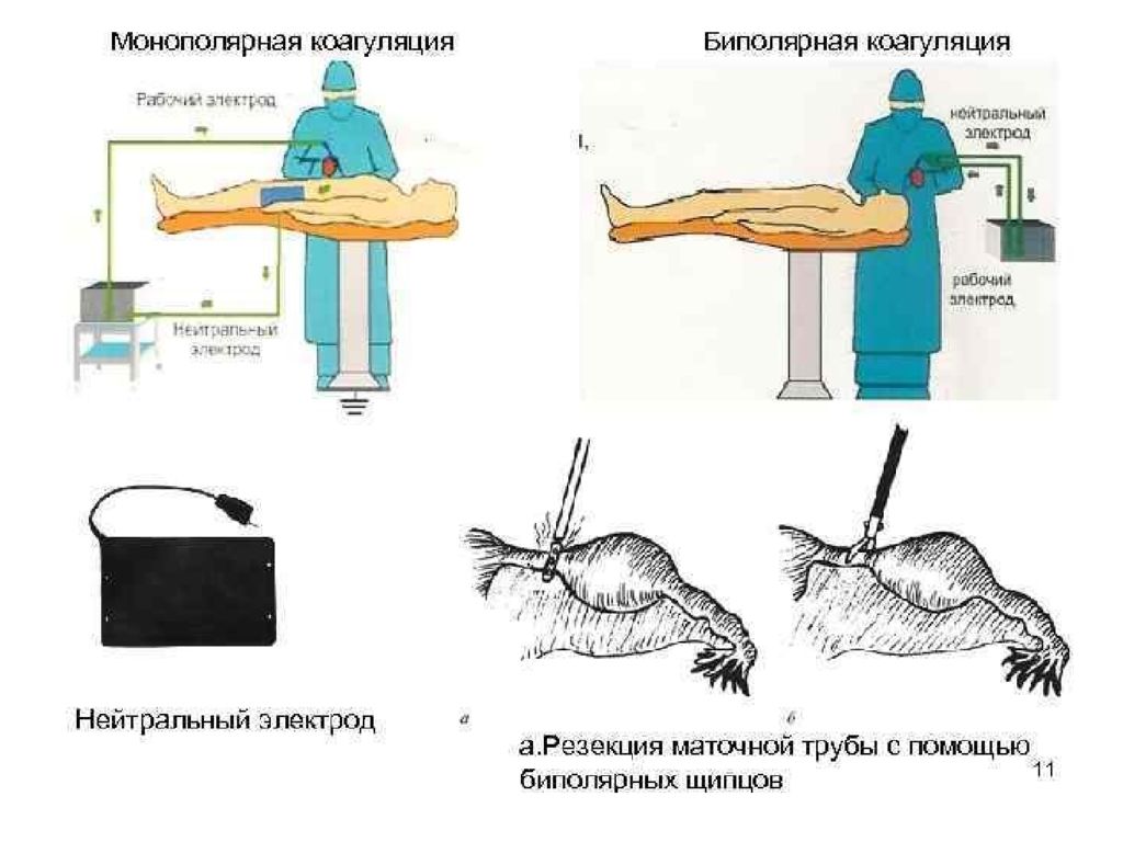 Аденомэктомия операция. Радикальная позадилонная простатэктомия ход операции. Радикальный хирургический метод простатэктомия. Гиперплазия предстательной железы holep. Биполярная резекция.