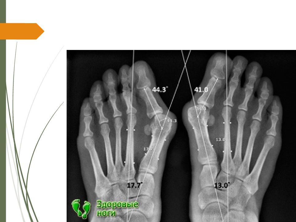 Хальгус вальгус рентген москва