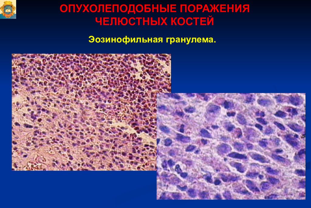 Опухоли опухолеподобные поражения и кисты кожи лица презентация