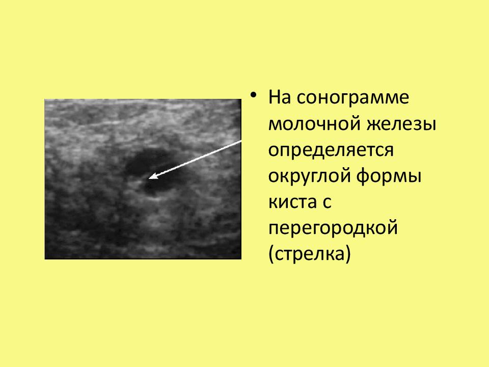 Киста железы у женщин. Исследование молочных желез. Обследование молочной железы. Метод обследования молочных желез. Исследование молочных желез алгоритм.