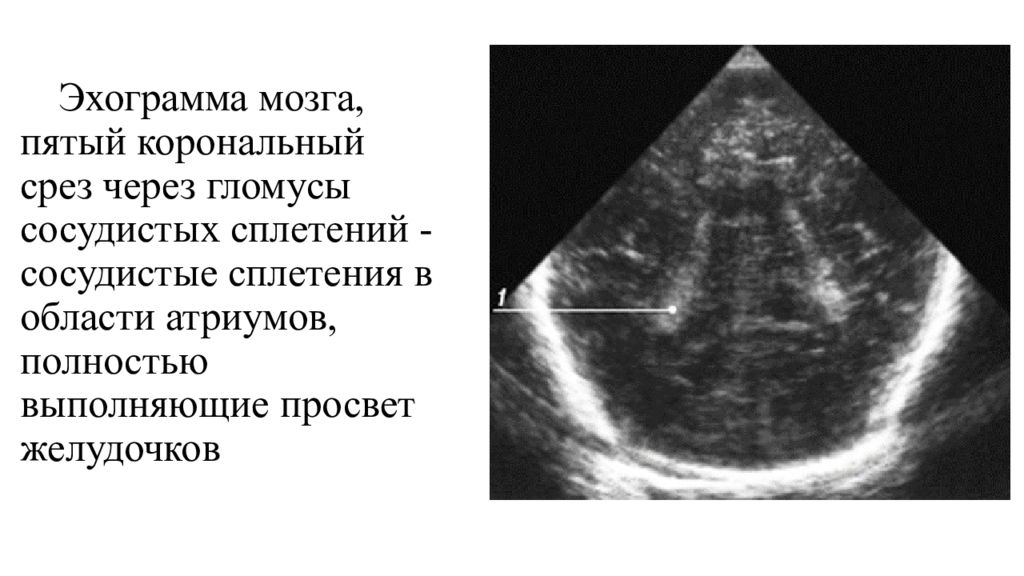 УЗИ головного мозга нейросонография. Эхограмма мозга. Нейросонография сечения. Нейросонография УЗИ анатомия.