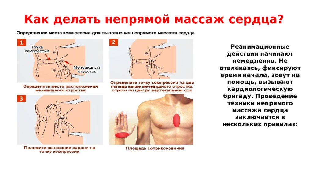 Проведение массажа сердца. Непрямой массаж сердца техника выполнения. Алгоритм проведения наружного непрямого массажа сердца. Порядок выполнения непрямого массажа сердца кратко. Прямой массаж сердца алгоритм действий.