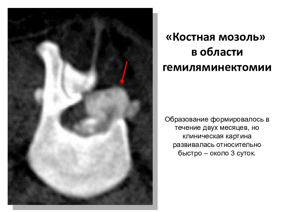 Костяная мозоль. Костная мозоль на челюсти. Образование костной мозоли кт. Формирование костной мозоли на кт.