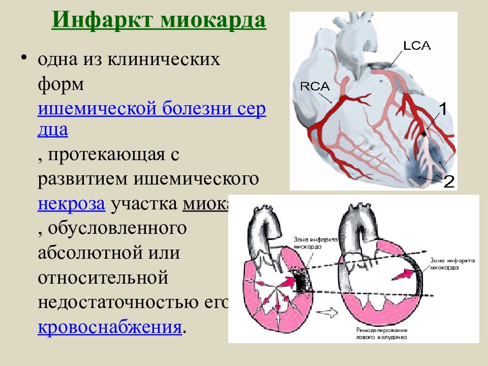 Сердечная форма. Инфаркт миокарда одна из клинических форм.