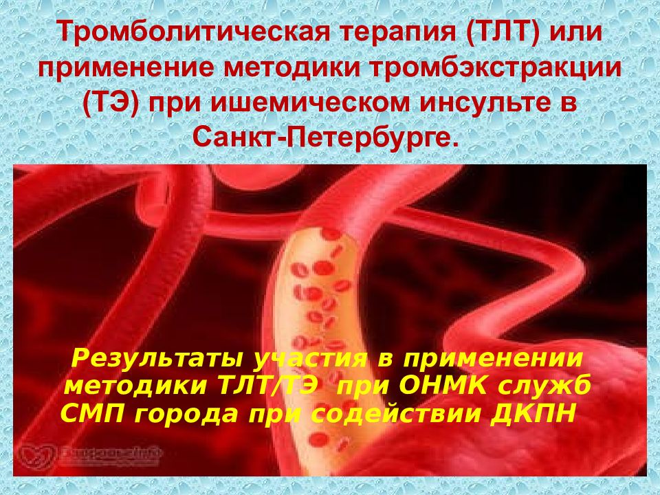 Тромбоэкстракция при ишемическом. Тромболитическая терапия. Регионарный катетерный тромболизис. Эндоваскулярная тромбоэкстракция это. Тромбоэкстракция при ишемическом инсульте.