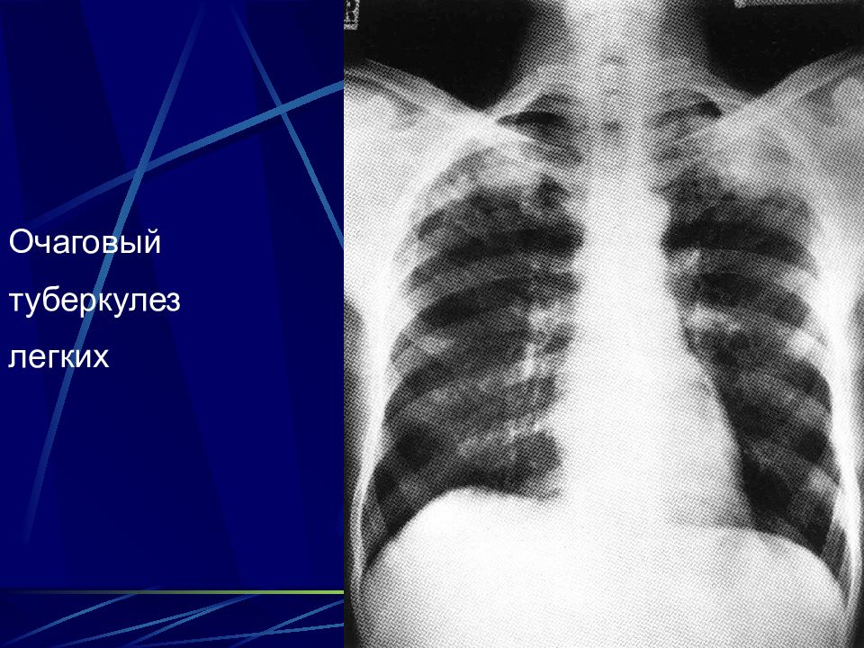 Очаговый туберкулез. Очаговый туберкулез легких. Очаговый туберкулёз лёгких. Очаговый туберкулез легких рентген. Мягкоочаговый туберкулез легких.