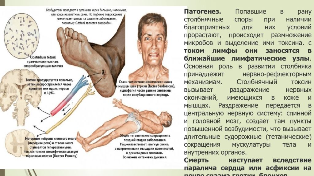 Симптомы столбняка. Столбняк патогенез кратко. Этиопатогенез столбняка. Патогенетический механизм столбняка. Столбняк этиология патогенез симптоматика.