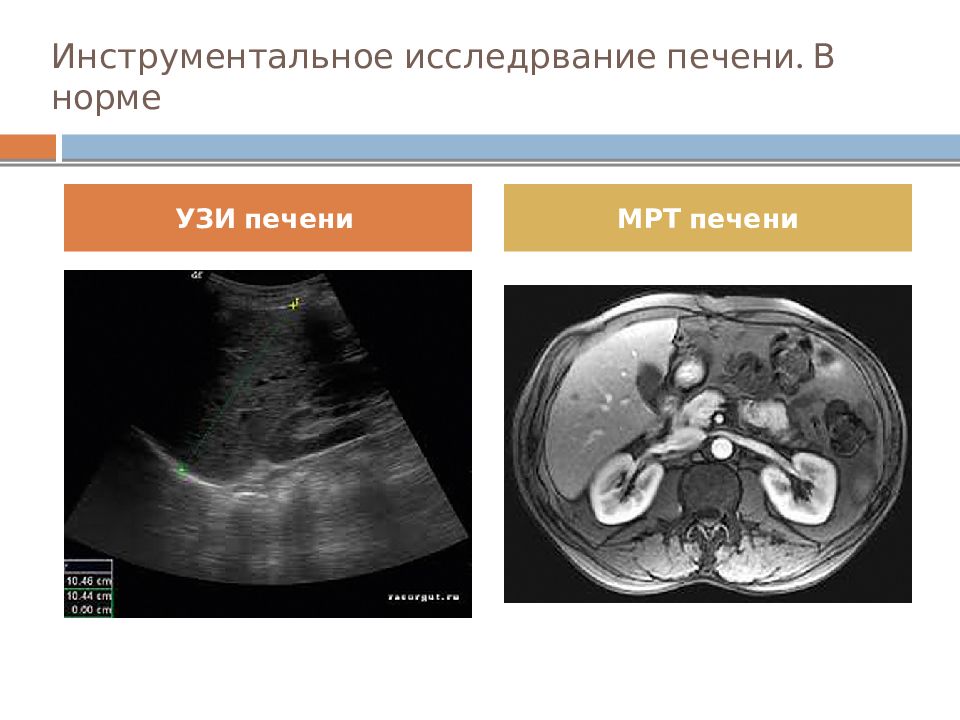 Мрт или узи. Нормальная печень на УЗИ. УЗИ печени норма. Ультразвуковое исследование печени норма.