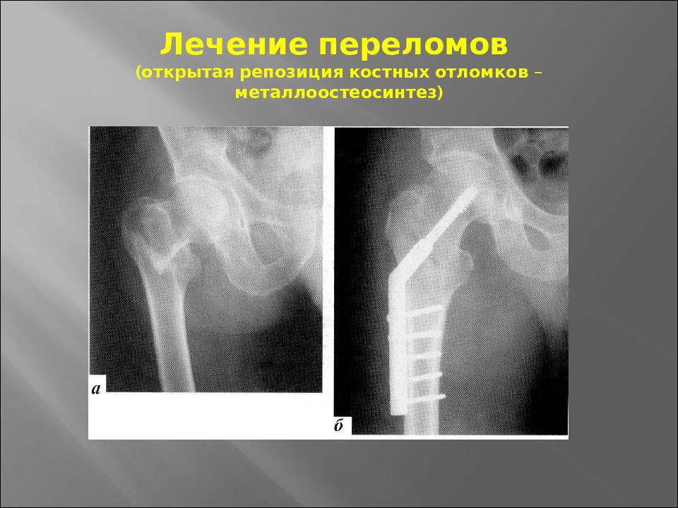 Травматология переломы презентация