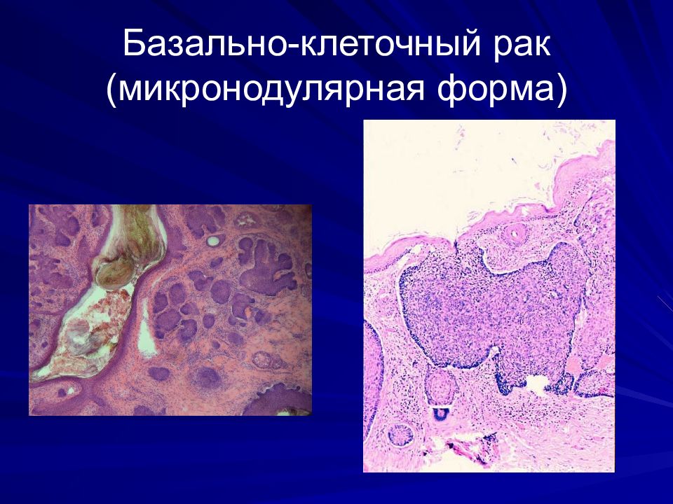 Клеточный рак. Базальноклеточная карцинома гистология. Базальноклеточная карцинома (рак кожи).. Клетки базально клеточной карциномы. Базалиома микропрепарат.