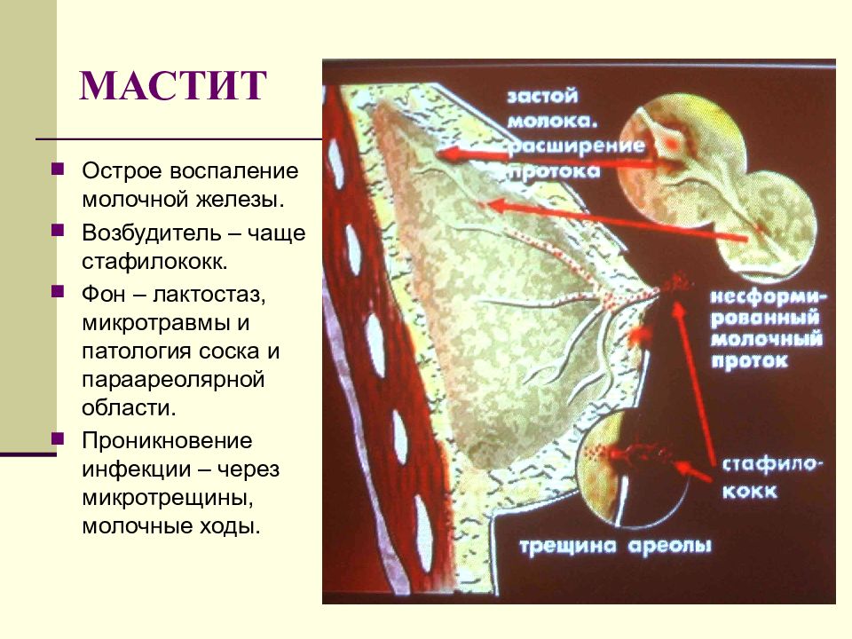 Сосудистый рисунок на молочной железе