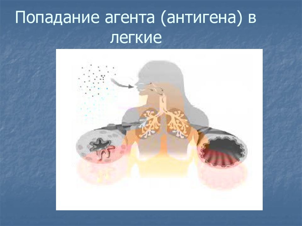 Синдром бронхиальной эктазии. Попадание агента в легкие картинка. Если крошки попали в легкие.