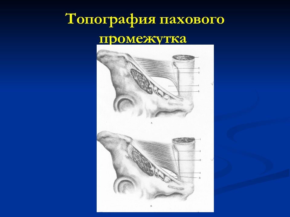 Паховые кольца у футболистов. Топография пахового канала. Паховый промежуток топографическая анатомия. Строение пахового канала топографическая анатомия.