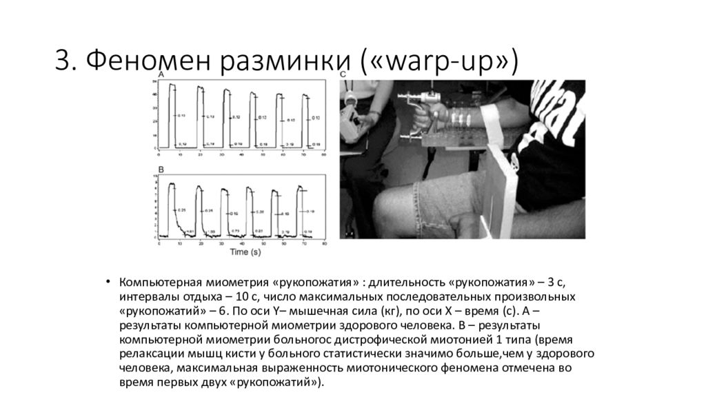 Феномен 3. Миотонический способ возбуждения. Миотонический кисть. Дети с миотоническим синдром.