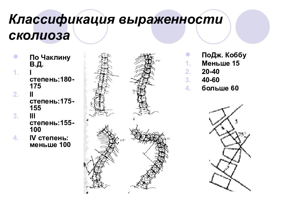 Степени сколиоза картинки