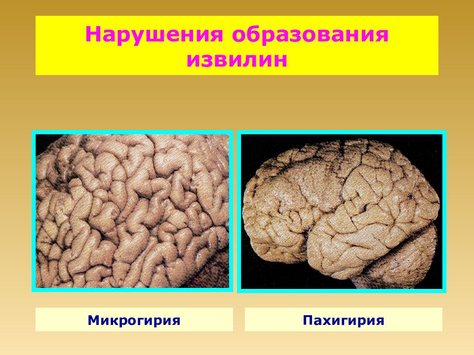 Нарушение образования. Микрогирия кт. Пахигирия лобной доли.