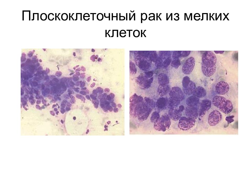 Цитологическая картина базальноклеточного рака