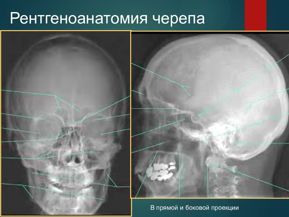 Кости черепа рентген. Рентгеноанатомия черепа пазухи. Рентгенанатомия Церема. Рентгенограмма черепа в боковой проекции. Рентгеноанатрммя череп.