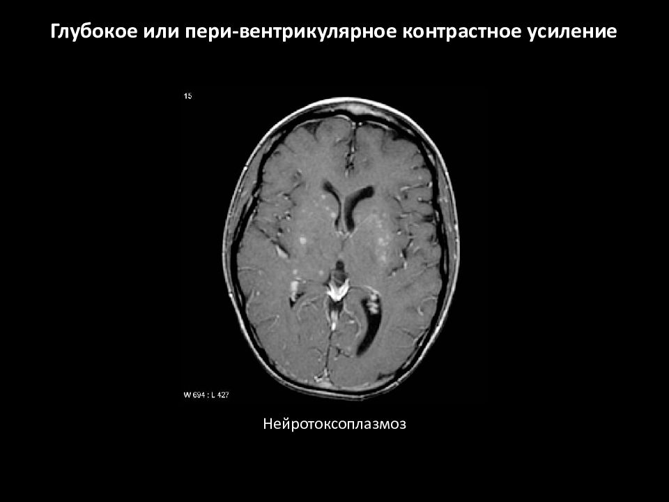 Мрт с контрастным усилением. Нейротоксоплазмоз мрт. Контрастное усиление при мрт. Мрт глубокое или Пери-вентрикулярное контрастное усиление схема. Типы контрастного усиления на мрт.