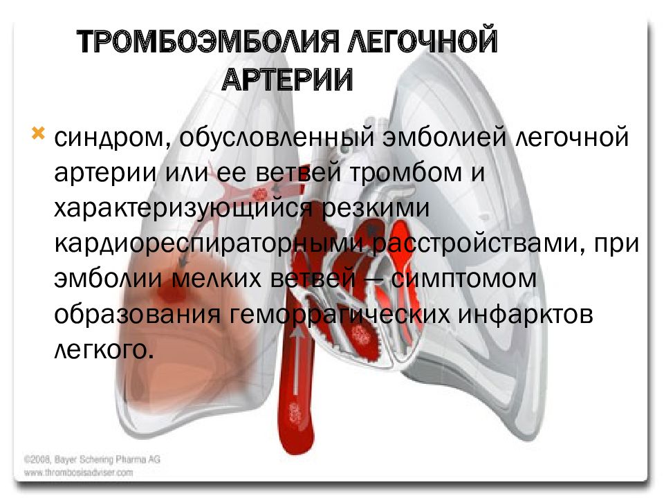 Что такое тромбоэмболия легочной артерии простыми