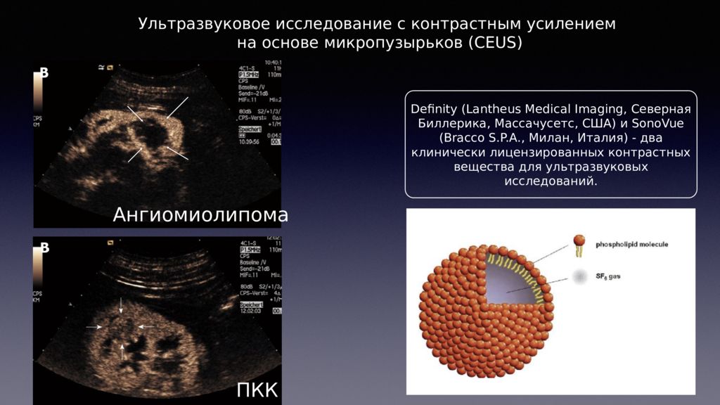 УЗИ С контрастным усилением. Новообразования в почках УЗИ. Ультразвуковые контрастные вещества. УЗИ почек презентация.