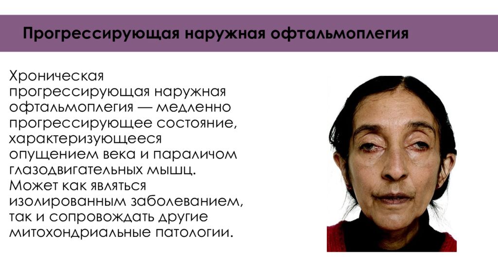 Офтальмоплегия. Прогрессирующая наружная офтальмоплегия. Синдром наружной офтальмоплегии.