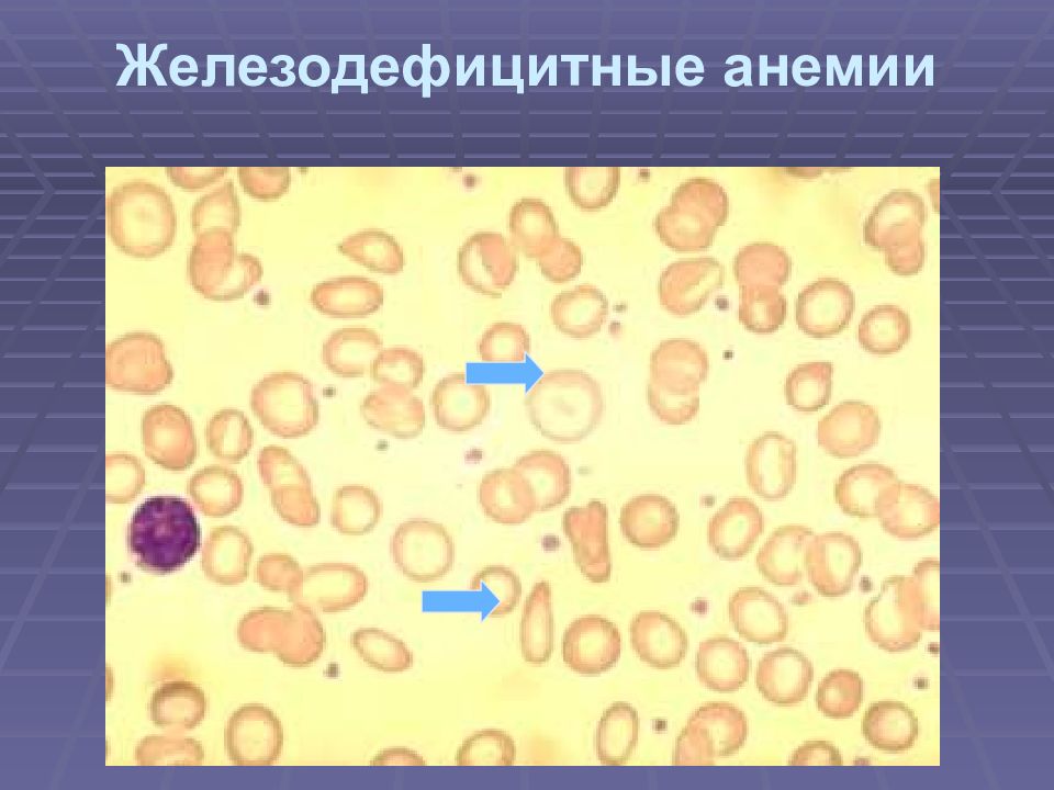 Картины анемии. Железодефицитная анемия мазок крови. Мазок крови при железодефицитной анемии. Железодефицитная анемия микроскопия.