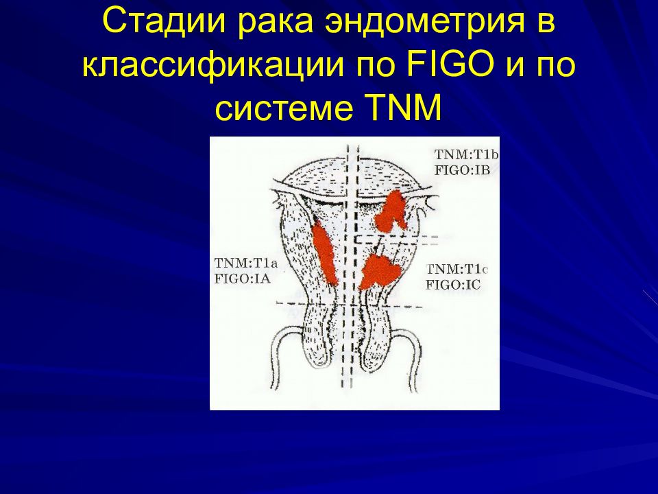 Рак тела матки презентация