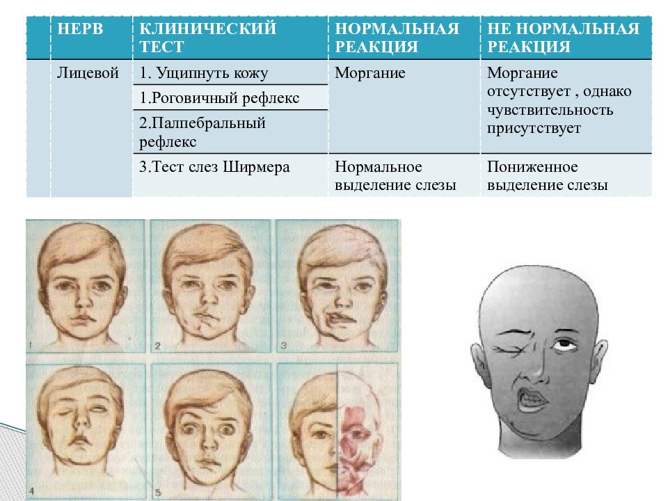 Симптомы поражения черепных нервов. Методика исследования поражения лицевого нерва. Черепно лицевое дублирование всего лица. Поражение 4 пары черепных нервов.