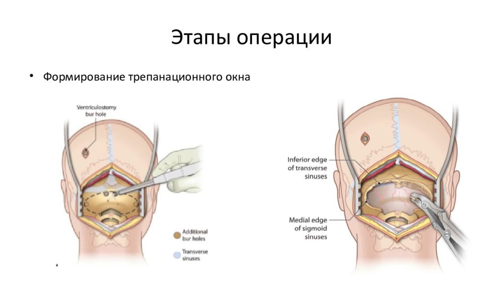 Операция формирования. Декомпрессивная краниэктомия. Этапы операции презентация.