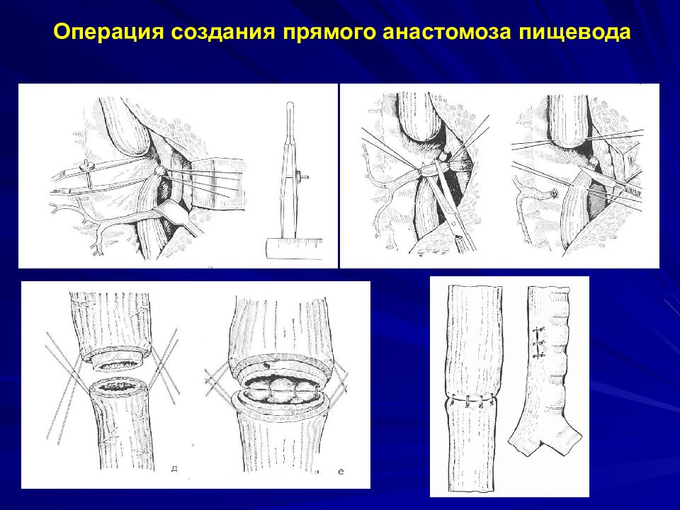 Анастомоз пищевода. Операция по атрезии пищевода. Операции при атрезии пищевода прямой анастомоз. Операции при атрезии пищевода. Анастомоз при атрезии пищевода.