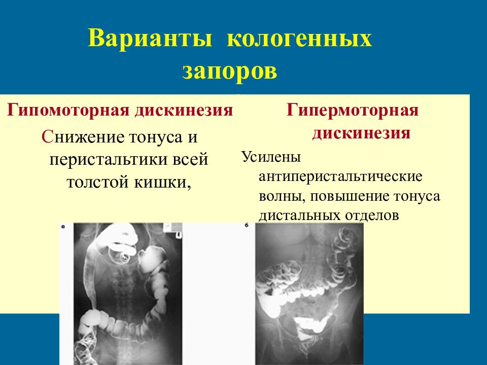 Дискинезия кишечника. Гипомоторная дискинезия кишечника. Гипомоторная дискинезия Толстого кишечника. Дискинезии Толстого кишечника. Гипомоторная и гипермоторная дискинезия.