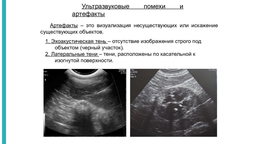 Виды узи. Артефакт реверберации на УЗИ. Артефакт псевдоусиления УЗИ. Ультразвуковые артефакты.