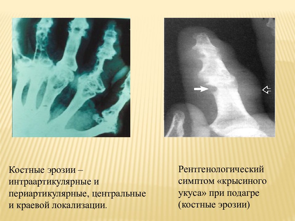 Подагра рентген. Костные эрозии рентген. Рентген при подагре заключение. Подагрический артрит рентген признаки.