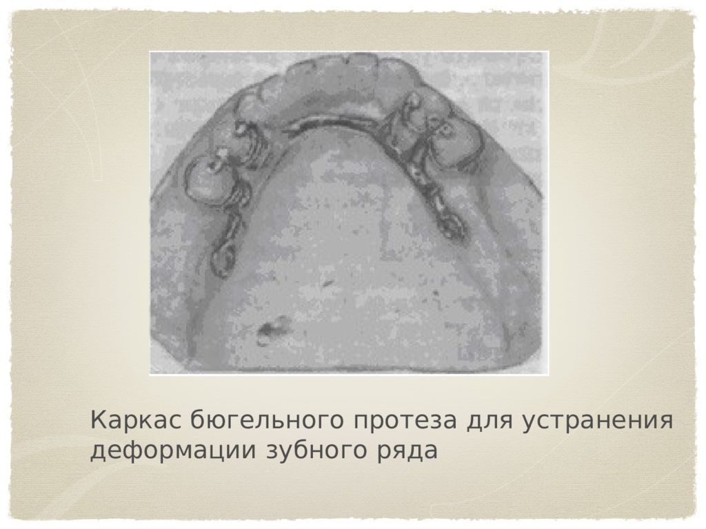 Окклюзионная накладка бюгельного протеза. Основы окклюзионной диагностики. Диагностика окклюзионных нарушений.