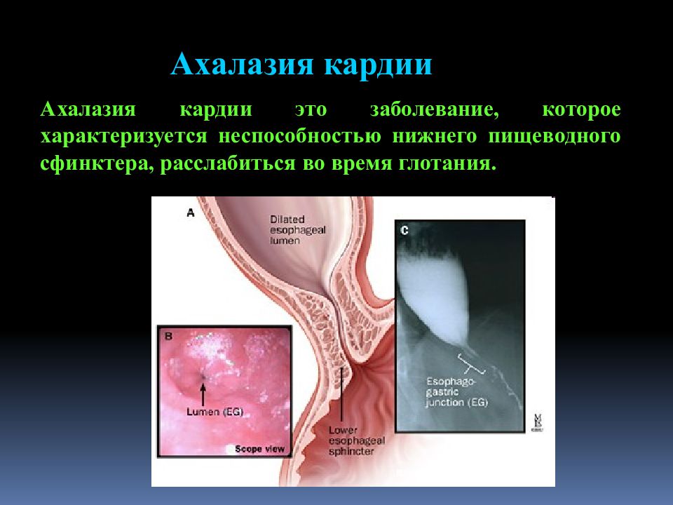 Ахалазия кардии пищевода